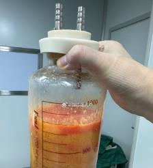 吐鲁番水动力吸脂手术要做多久？
